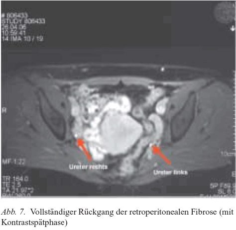 vollst&auml;ndiger r&uuml;ckgang von MO